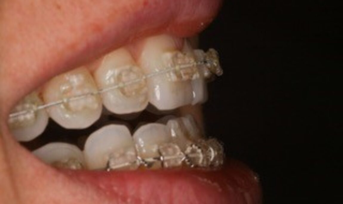 Blog - Absolute Dental